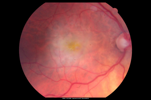 Classic Subfoveal Choroidal Neovascular Membrane - 20/400 Vision - 6 - 12 months old lesion
78-year-old woman six months or a year ago decreasing vision in the right eye.   OD 20/400. Fluorescein angiography shows a classic subfoveal choroidal neovascular membrane  in the right eye 3 disc-diameters across, which has brisk leakage.  The left eye shows staining drusen.  

Keywords: choroidal neovascular membrane;classic;subfoveal;cartwheel