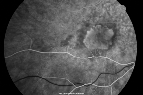 Classic Subfoveal Choroidal Neovascular Membrane - 20/400 Vision - 6 - 12 months old lesion
78-year-old woman six months or a year ago decreasing vision in the right eye.   OD 20/400. Fluorescein angiography shows a classic subfoveal choroidal neovascular membrane  in the right eye 3 disc-diameters across, which has brisk leakage.  The left eye shows staining drusen.  

Schlüsselwörter: choroidal neovascular membrane;classic;subfoveal;cartwheel