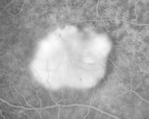 Classic Subfoveal Choroidal Neovascular Membrane - 20/400 Vision - 6 - 12 months old lesion
78-year-old woman six months or a year ago decreasing vision in the right eye.   OD 20/400. Fluorescein angiography shows a classic subfoveal choroidal neovascular membrane  in the right eye 3 disc-diameters across, which has brisk leakage.  The left eye shows staining drusen.  

Mots-clés: choroidal neovascular membrane;classic;subfoveal;cartwheel