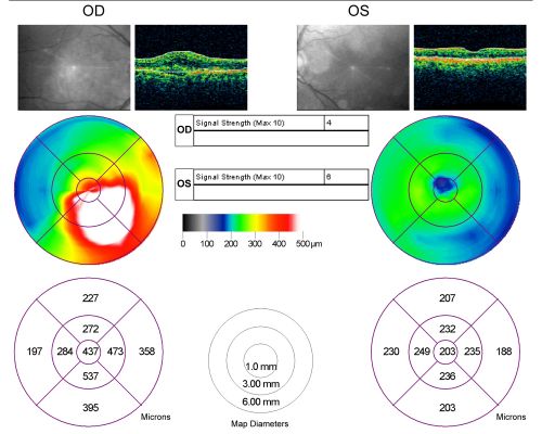 Classic Subfoveal Choroidal Neovascular Membrane - 20/400 Vision - 6 - 12 months old lesion
78-year-old woman six months or a year ago decreasing vision in the right eye.   OD 20/400. Fluorescein angiography shows a classic subfoveal choroidal neovascular membrane  in the right eye 3 disc-diameters across, which has brisk leakage.  The left eye shows staining drusen.  

Keywords: choroidal neovascular membrane;classic;subfoveal;cartwheel