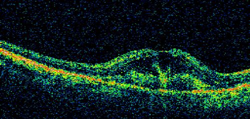 Classic Subfoveal Choroidal Neovascular Membrane - 20/400 Vision - 6 - 12 months old lesion
78-year-old woman six months or a year ago decreasing vision in the right eye.   OD 20/400. Fluorescein angiography shows a classic subfoveal choroidal neovascular membrane  in the right eye 3 disc-diameters across, which has brisk leakage.  The left eye shows staining drusen.  

Keywords: choroidal neovascular membrane;classic;subfoveal;cartwheel