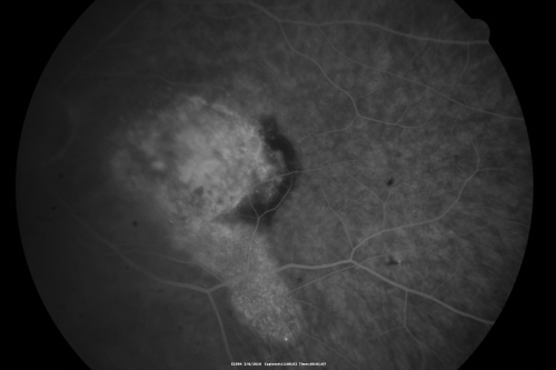 Wet Macular Degeneration Left Eye with Gutter (atypical) and Geographic Atrophy Right Eye
80-year-old man has wet age-related macular degeneration in his left eye. He has an atypical angiogram and that there is a gutter under the choroidal neovascular membrane suggesting still leakage of subretinal fluid.  OS 20/400.
