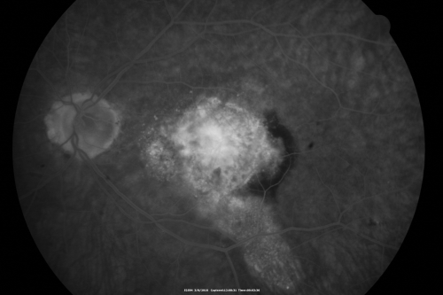 Wet Macular Degeneration Left Eye with Gutter (atypical) and Geographic Atrophy Right Eye
80-year-old man has wet age-related macular degeneration in his left eye. He has an atypical angiogram and that there is a gutter under the choroidal neovascular membrane suggesting still leakage of subretinal fluid.  OS 20/400.
