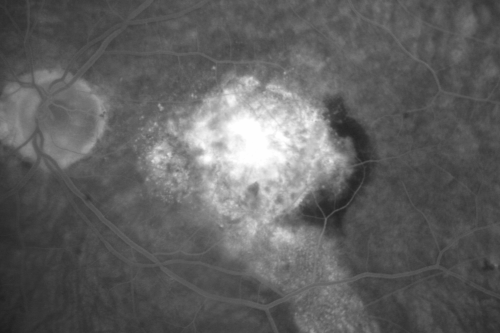 Wet Macular Degeneration Left Eye with Gutter (atypical) and Geographic Atrophy Right Eye
80-year-old man has wet age-related macular degeneration in his left eye. He has an atypical angiogram and that there is a gutter under the choroidal neovascular membrane suggesting still leakage of subretinal fluid.  OS 20/400.
