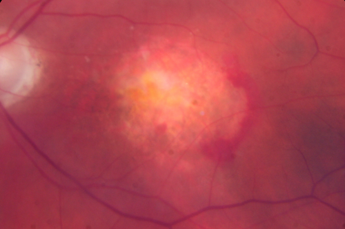 Wet Macular Degeneration Left Eye with Gutter (atypical) and Geographic Atrophy Right Eye
80-year-old man has wet age-related macular degeneration in his left eye. He has an atypical angiogram and that there is a gutter under the choroidal neovascular membrane suggesting still leakage of subretinal fluid.  OS 20/400.
