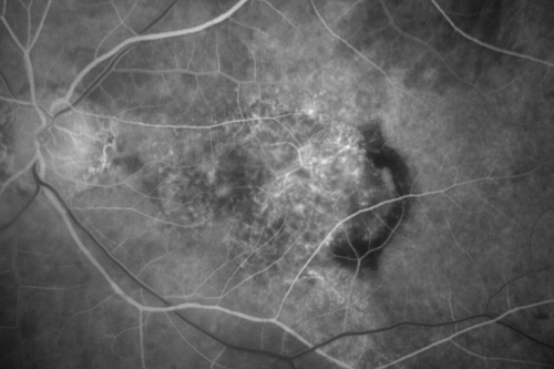 Wet Macular Degeneration Left Eye with Gutter (atypical) and Geographic Atrophy Right Eye
80-year-old man has wet age-related macular degeneration in his left eye. He has an atypical angiogram and that there is a gutter under the choroidal neovascular membrane suggesting still leakage of subretinal fluid.  OS 20/400.
