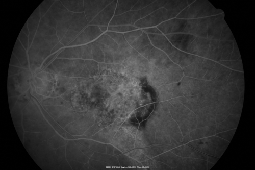 Wet Macular Degeneration Left Eye with Gutter (atypical) and Geographic Atrophy Right Eye
80-year-old man has wet age-related macular degeneration in his left eye. He has an atypical angiogram and that there is a gutter under the choroidal neovascular membrane suggesting still leakage of subretinal fluid.  OS 20/400.
