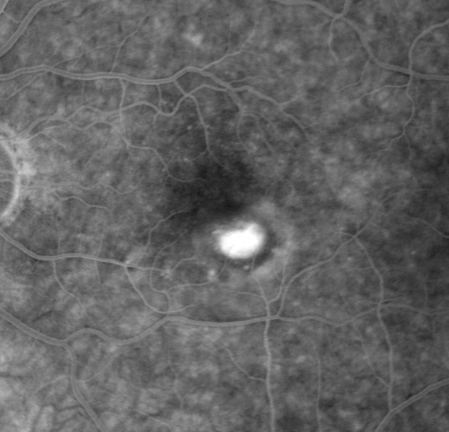 Wet AMD 62 year old male smoker 
62-year-old man has wet age-related macular degeneration in the right eye.  He has been undergoing treatment with Lucentis for that.  Then his left eye developed hazy vision a few weeks ago while he was overseas and now his vision is hazy in both eyes.   OD 20/40, OS 20/30.    FA shows a classic subfoveal choroidal neovascular membrane in the left eye, which is leaking and in the right eye, which is dry. He is going to stop smoking today. FU: VA 20/30 OU with 2 years of every 6 weeks bilateral avastin!
Keywords: wet amd; smoker; avastin; bilateral