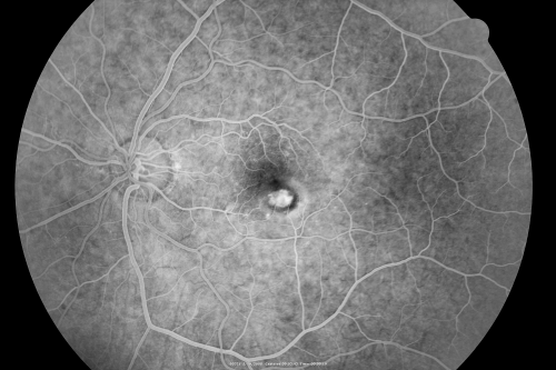Wet AMD 62 year old male smoker 
62-year-old man has wet age-related macular degeneration in the right eye.  He has been undergoing treatment with Lucentis for that.  Then his left eye developed hazy vision a few weeks ago while he was overseas and now his vision is hazy in both eyes.   OD 20/40, OS 20/30.    FA shows a classic subfoveal choroidal neovascular membrane in the left eye, which is leaking and in the right eye, which is dry. He is going to stop smoking today. FU: VA 20/30 OU with 2 years of every 6 weeks bilateral avastin!
Keywords: wet amd; smoker; avastin; bilateral
