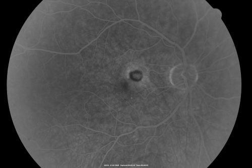 Wet AMD 62 year old male smoker 
62-year-old man has wet age-related macular degeneration in the right eye.  He has been undergoing treatment with Lucentis for that.  Then his left eye developed hazy vision a few weeks ago while he was overseas and now his vision is hazy in both eyes.   OD 20/40, OS 20/30.    FA shows a classic subfoveal choroidal neovascular membrane in the left eye, which is leaking and in the right eye, which is dry. He is going to stop smoking today. FU: VA 20/30 OU with 2 years of every 6 weeks bilateral avastin!
Keywords: wet amd; smoker; avastin; bilateral