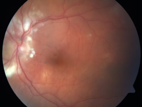 Wet Macular Degeneration with Juxtapapillary Neovascular Membrane and Choroidal Laser Treatment
87-year-old woman has wet age-related macular degeneration in the left eye with an extrafoveal choroidal neovascular membrane OD is 20/25, OS is 20/25
