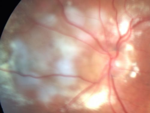 Wet Macular Degeneration with Juxtapapillary Neovascular Membrane and Choroidal Laser Treatment
87-year-old woman has wet age-related macular degeneration in the left eye with an extrafoveal choroidal neovascular membrane OD is 20/25, OS is 20/25

White spots are laser treatment (fresh)
