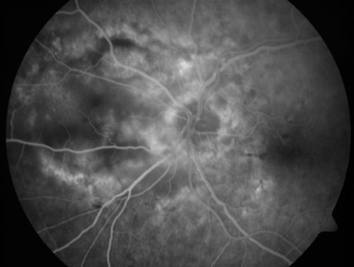 Wet Macular Degeneration with Juxtapapillary Neovascular Membrane and Choroidal Laser Treatment
87-year-old woman has wet age-related macular degeneration in the left eye with an extrafoveal choroidal neovascular membrane OD is 20/25, OS is 20/25
