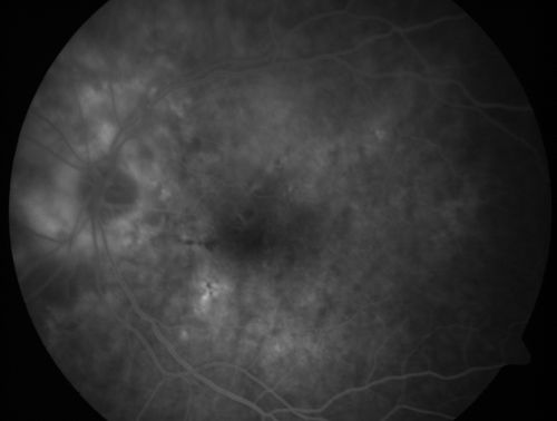 Wet Macular Degeneration with Juxtapapillary Neovascular Membrane and Choroidal Laser Treatment
87-year-old woman has wet age-related macular degeneration in the left eye with an extrafoveal choroidal neovascular membrane OD is 20/25, OS is 20/25
