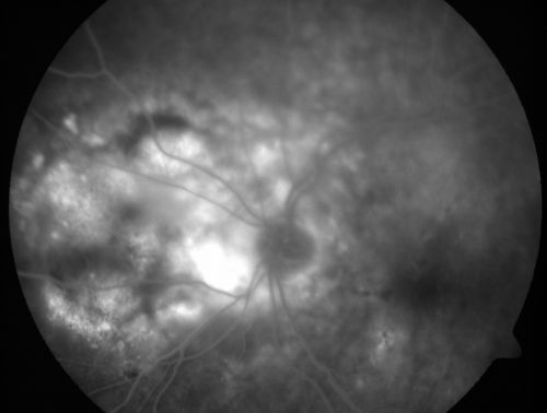 Wet Macular Degeneration with Juxtapapillary Neovascular Membrane and Choroidal Laser Treatment
87-year-old woman has wet age-related macular degeneration in the left eye with an extrafoveal choroidal neovascular membrane OD is 20/25, OS is 20/25
