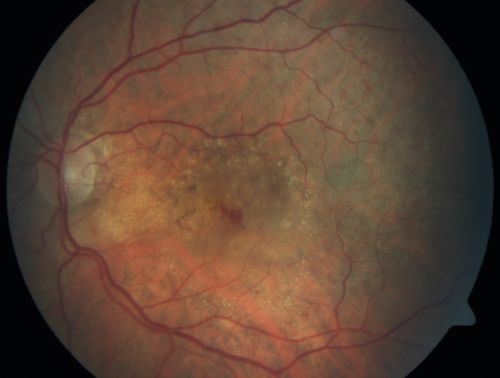 Wet AMD - PED with exudate 20/400 87 Year old
87-year-old woman has wet age-related macular degeneration in the left eye.    Vision OD is 20/25, OS is 20/400
