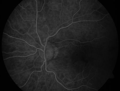 Pigment Epithelial Detachment with Subretinal Fluid and Exudate 20/400 Vision
87-year-old woman has wet age-related macular degeneration in the left eye.  She had treatment up north but there has been a gap in therapy and the vision in the left eye is poor.  Vision OD is 20/25, OS is 20/400
