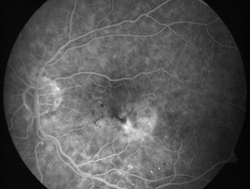 Wet AMD - PED with exudate 20/400 87 Year old
87-year-old woman has wet age-related macular degeneration in the left eye.    Vision OD is 20/25, OS is 20/400
