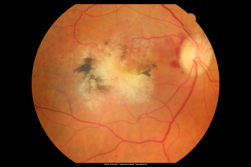Chorioretinal Scar with Radiating Chorioretinal Folds
79-year-old woman has wet age-related macular degeneration in both eyes.  The left eye had intravitreal injections of Avastin starting in May of 2009.  Her vision remains good in the left eye and poor in the right eye.  

VISUAL ACUITY:  OD 8/200,  OS 20/60.
