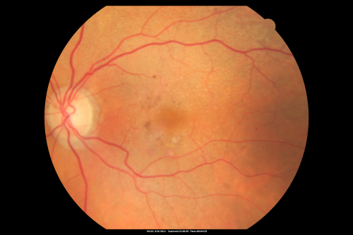 Wet AMD controlled with Avastin 20/60 Vision
79-year-old woman has wet age-related macular degeneration in both eyes.  The left eye had intravitreal injections of Avastin starting in May of 2009.  Her vision remains good in the left eye and poor in the right eye.  

VISUAL ACUITY:  OD 8/200,  OS 20/60.
