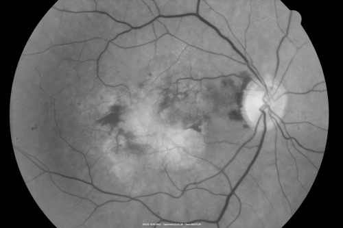 Chorioretinal Scar with Radiating Chorioretinal Folds
79-year-old woman has wet age-related macular degeneration in both eyes.  The left eye had intravitreal injections of Avastin starting in May of 2009.  Her vision remains good in the left eye and poor in the right eye.  

VISUAL ACUITY:  OD 8/200,  OS 20/60.
