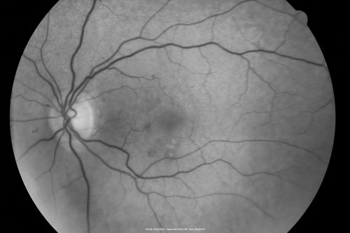 Wet AMD controlled with Avastin 20/60 Vision
79-year-old woman has wet age-related macular degeneration in both eyes.  The left eye had intravitreal injections of Avastin starting in May of 2009.  Her vision remains good in the left eye and poor in the right eye.  

VISUAL ACUITY:  OD 8/200,  OS 20/60.
