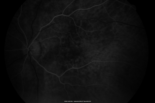 Wet AMD controlled with Avastin 20/60 Vision
79-year-old woman has wet age-related macular degeneration in both eyes.  The left eye had intravitreal injections of Avastin starting in May of 2009.  Her vision remains good in the left eye and poor in the right eye.  

VISUAL ACUITY:  OD 8/200,  OS 20/60.
