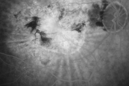 Chorioretinal Scar with Radiating Chorioretinal Folds
79-year-old woman has wet age-related macular degeneration in both eyes.  The left eye had intravitreal injections of Avastin starting in May of 2009.  Her vision remains good in the left eye and poor in the right eye.  

VISUAL ACUITY:  OD 8/200,  OS 20/60.
