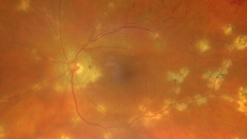 West Nile Virus Multifocal Choroiditis with later CNVM
77 year old female with vision loss in the left eye treated with Anti-VEGF

