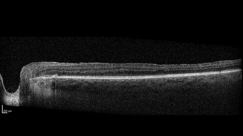 West Nile Virus Multifocal Choroiditis with later CNVM
77 year old female with vision loss in the left eye treated with Anti-VEGF
