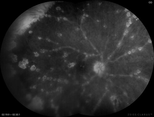 West Nile Virus Multifocal Choroiditis with later CNVM
77 year old female with vision loss in the left eye treated with Anti-VEGF
