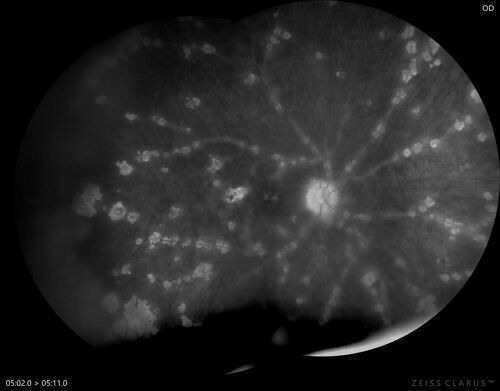 West Nile Virus Multifocal Choroiditis with later CNVM
77 year old female with vision loss in the left eye treated with Anti-VEGF
