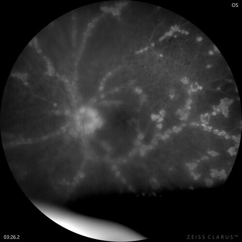West Nile Virus Multifocal Choroiditis with later CNVM
77 year old female with vision loss in the left eye treated with Anti-VEGF
