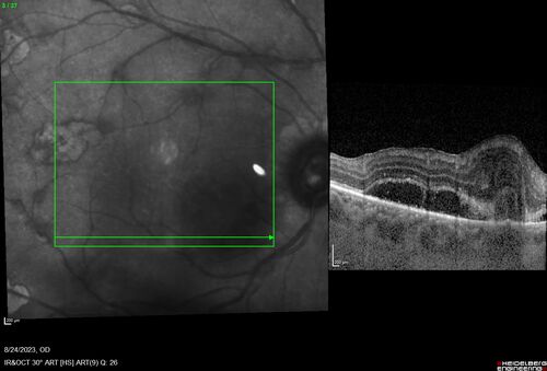 West Nile Virus Multifocal Choroiditis with later CNVM
77 year old female with vision loss in the left eye treated with Anti-VEGF
