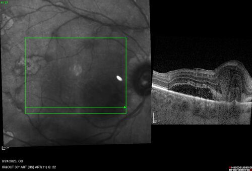 West Nile Virus Multifocal Choroiditis with later CNVM
77 year old female with vision loss in the left eye treated with Anti-VEGF
