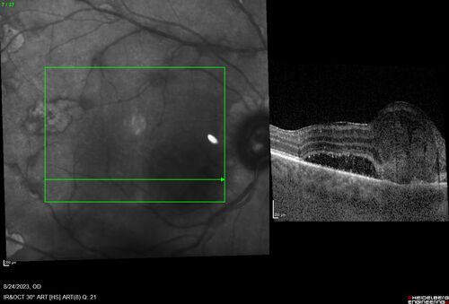 West Nile Virus Multifocal Choroiditis with later CNVM
77 year old female with vision loss in the left eye treated with Anti-VEGF
