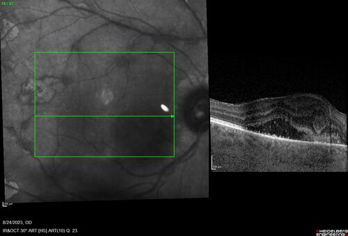 West Nile Virus Multifocal Choroiditis with later CNVM
77 year old female with vision loss in the left eye treated with Anti-VEGF
