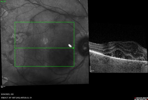 West Nile Virus Multifocal Choroiditis with later CNVM
77 year old female with vision loss in the left eye treated with Anti-VEGF
