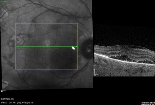 West Nile Virus Multifocal Choroiditis with later CNVM
77 year old female with vision loss in the left eye treated with Anti-VEGF
