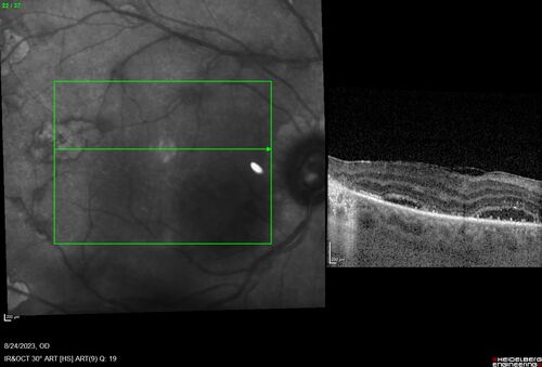 West Nile Virus Multifocal Choroiditis with later CNVM
77 year old female with vision loss in the left eye treated with Anti-VEGF
