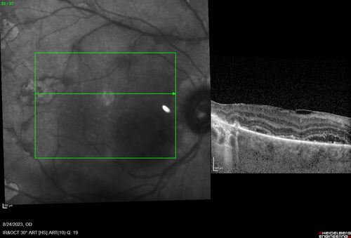 West Nile Virus Multifocal Choroiditis with later CNVM
77 year old female with vision loss in the left eye treated with Anti-VEGF
