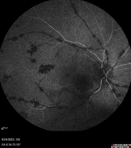 West Nile Virus Multifocal Choroiditis with later CNVM
77 year old female with vision loss in the left eye treated with Anti-VEGF
