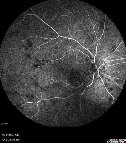 West Nile Virus Multifocal Choroiditis with later CNVM
77 year old female with vision loss in the left eye treated with Anti-VEGF
