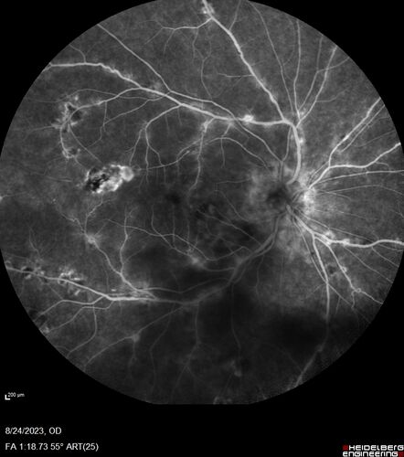 West Nile Virus Multifocal Choroiditis with later CNVM
77 year old female with vision loss in the left eye treated with Anti-VEGF
