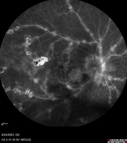 West Nile Virus Multifocal Choroiditis with later CNVM
77 year old female with vision loss in the left eye treated with Anti-VEGF
