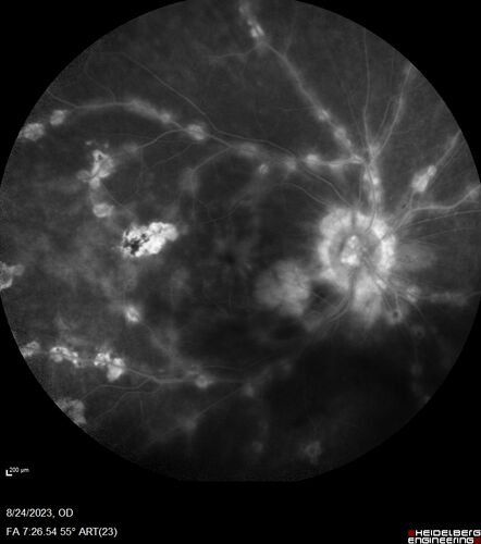 West Nile Virus Multifocal Choroiditis with later CNVM
77 year old female with vision loss in the left eye treated with Anti-VEGF
