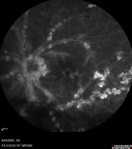West Nile Virus Multifocal Choroiditis with later CNVM
77 year old female with vision loss in the left eye treated with Anti-VEGF
