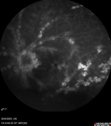 West Nile Virus Multifocal Choroiditis with later CNVM
77 year old female with vision loss in the left eye treated with Anti-VEGF
