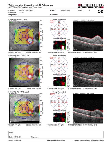West Nile Virus Multifocal Choroiditis with later CNVM
77 year old female with vision loss in the left eye treated with Anti-VEGF

