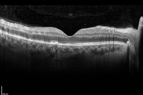 West Nile Virus Multifocal Choroiditis and diabetic retinopathy
Multifocal and clustered focal lesions are from west nile virus.  The retinopathy is probably diabetic but could also be related to west nile virus
